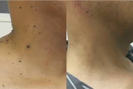 Penghilang Kutil Herba RICPIND SkinSpot