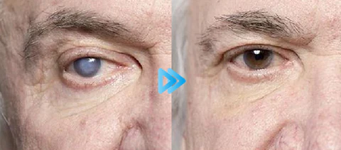 Seurico™ Myopia Reversal -silmätipat
