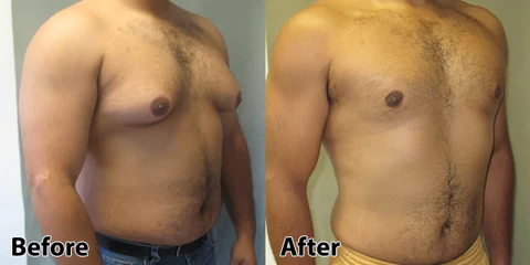 iRosesilk™ Microcurrent Chest Trainer