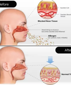 iRosesilk™ RespiRevive EMS Nasal Therapy Instrument