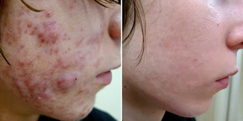 Dobshow™ Liquid SKIN PERFECTING 2% BHA