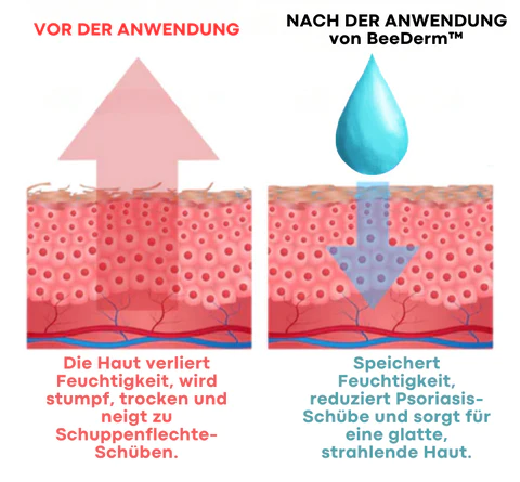 BeeDerm™ Bienengift Psoriasis Behandlungscreme