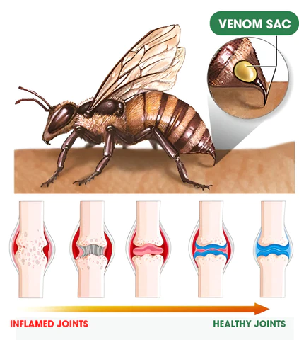 BeeZen™ Naujosios Zelandijos bičių nuodų sąnarių ir kaulų terapijos pažangus kremas