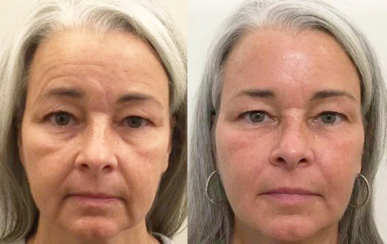 Ceoerty™ ReversiAge NMN Dual Repair Mask