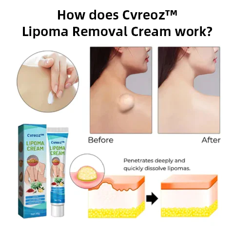 Cvreoz Bee Venom Lipomas Elimination Treatment Spray