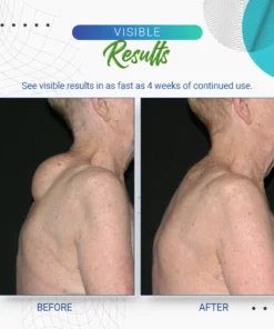 Cvreoz Lipoma Removal Cream