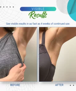 Cvreoz Lipoma Removal Cream