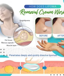 Cvreoz Lipoma Removal Cream