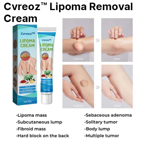 Cvreoz Lipoma Removal Cream