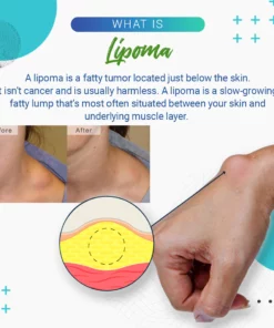 Cvreoz Lipoma Removal Cream