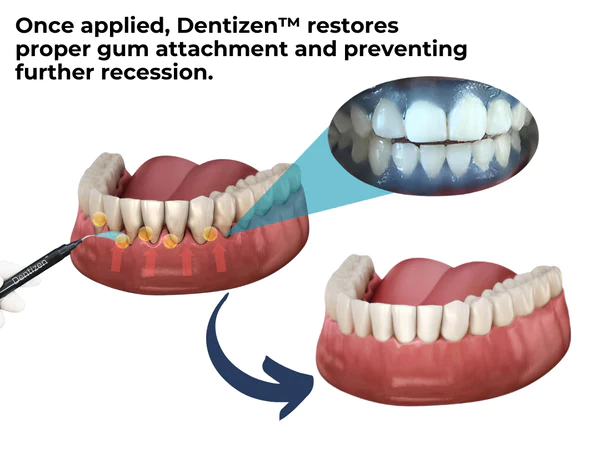 Dentizen™ Gum Therapy Agent