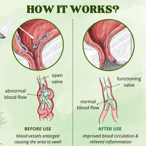 Dobshow™ Spray naturel pour hémorroïdes à base de plantes