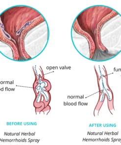 Spray de ervas naturais para hemorróidas Dobshow™