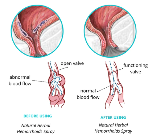 Dobshow™ Natural Herbal Hemorrhoids Spray