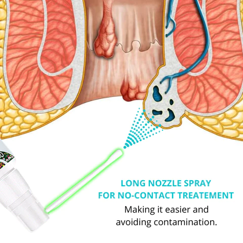 Природен растителен спреј за хемороиди Dobshow™