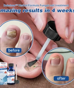 Dobshow™ Herbal Formula Fungal nail Paronychia treatment Gel