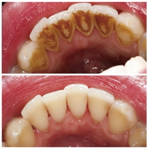 Dr. Smile SP-4TM Probiotic Rapid Whitening Toothpaste