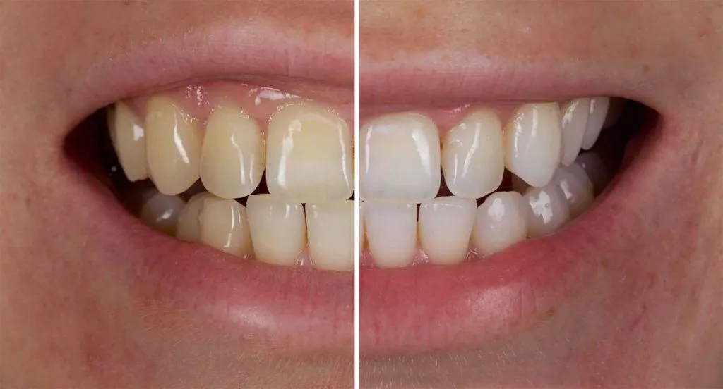 Dr. Smile SP-4TM Probiotic Rapid Whitening Toothpaste