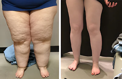 EXPECTSKY™ šorts sa Ice Silk ion Fiber Repair Shaper visokim strukom