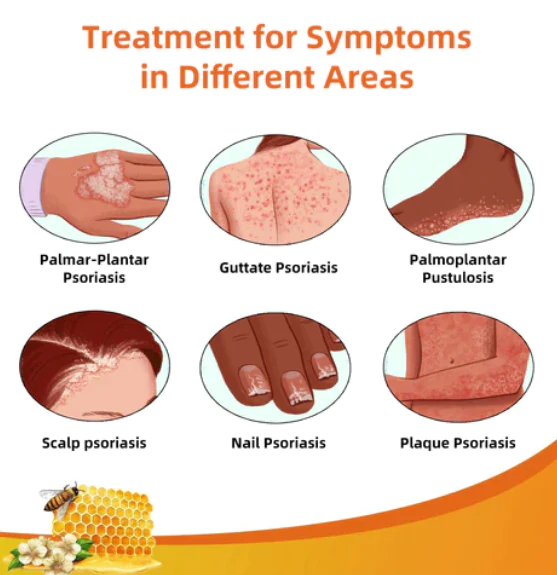 Fivfivgo™ BeeVenom Psoriasis-Lösungs-Creme