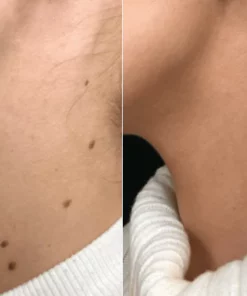 Fivfivgo™ SkinClear Sildid ja Maulwurfsentferner