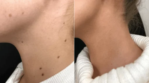Fivfivgo™ SkinClear Sildid ja Maulwurfsentferner
