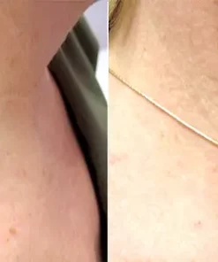 Fivfivgo™ SkinClear Sildid ja Maulwurfsentferner