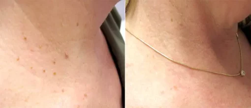 Fivfivgo™ SkinClear Sildid ja Maulwurfsentferner