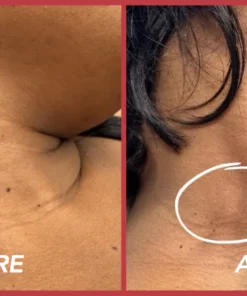Fivfivgo™ SkinClear Sildid ja Maulwurfsentferner