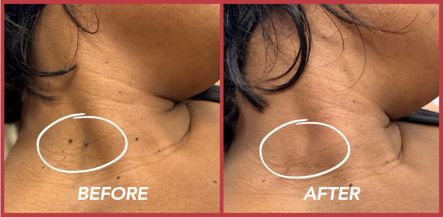 Fivfivgo™ SkinClear Sildid ja Maulwurfsentferner