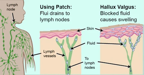 Fivfivgo™ Anti-Balgen-Pflaster