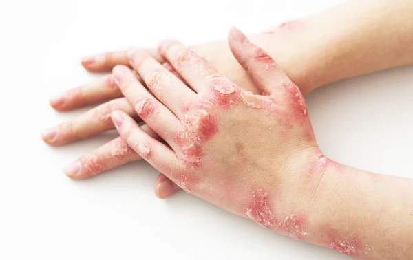 Fivfivgo™ BeeVenom Psoriasis-Lösungs-Creme