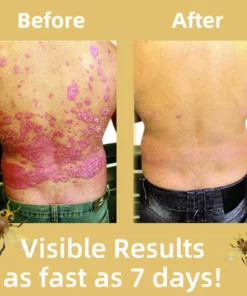 Fivfivgo™ BeeVenom Psoriasis-Lösungs-Creme