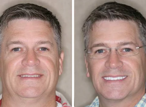 Fivfivgo™ Einrastbarer Zahnersatz