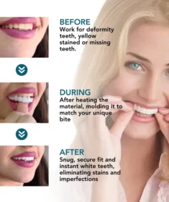 Fivfivgo™ Einrastbarer Zahnersatz