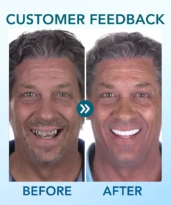 Fivfivgo™ Einrastbarer Zahnersatz