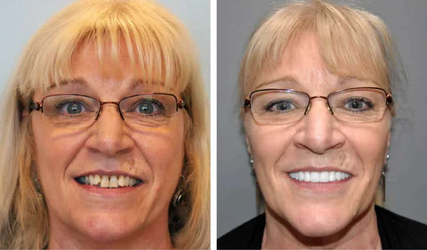 Fivfivgo™ Einrastbarer Zahnersatz