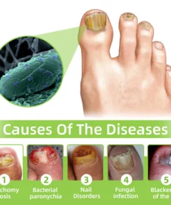 Fivfivgo™ Nagelpilz Laser-Behandlungsgerät