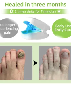 Fivfivgo™ Nagelpilz Laser-Behandlungsgerät