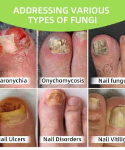 Fivfivgo™ Nagelpilz Laser-Behandlungsgerät