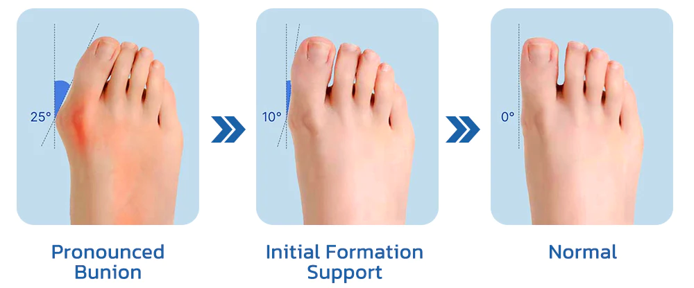 Fivfivgo™ Orthopädisch Ballenzeh Erleichterung Socken