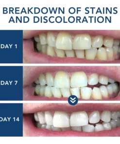 Oveallgo™ ProTeeth Whitening Kit