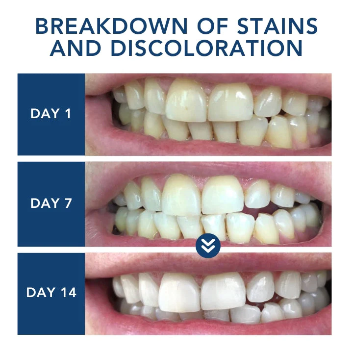 Fivfivgo™ ProTeeth Aufhellung Bausatz