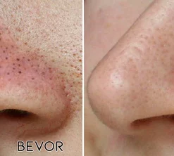 Fivfivgo™ Ultraschall-Porenabsauger BlackheadRemover PoreVacuum