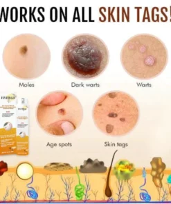 Fivfivgo™ Warze und Tags Entfernungsbehandlungsspray