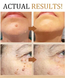 Fivfivgo™ Warze und Tags Entfernungsbehandlungsspray