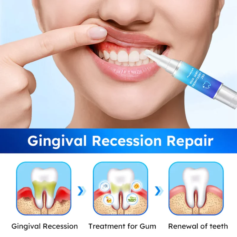 Fivfivgo™ Zahnfleischgel zur oralen Behandlung