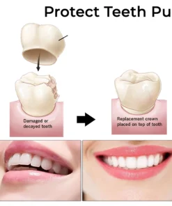 Fivfivgo™ Zahnprovisorische Kronenveneers für die Abdeckung der vorderen/hinteren Backenzähne