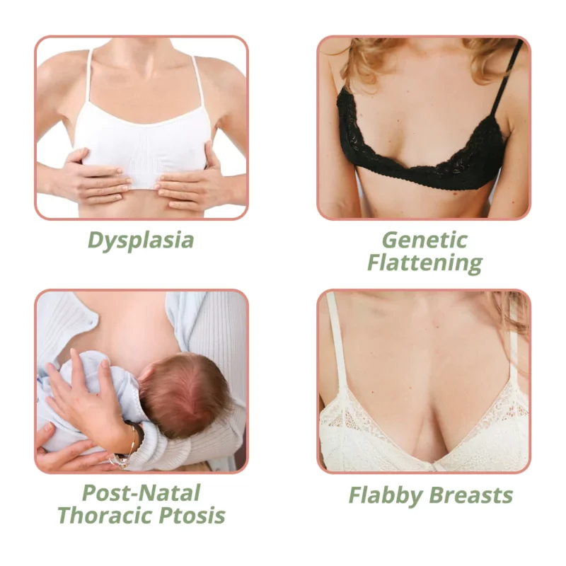 Flysmus™ Breast Augmentation Patch