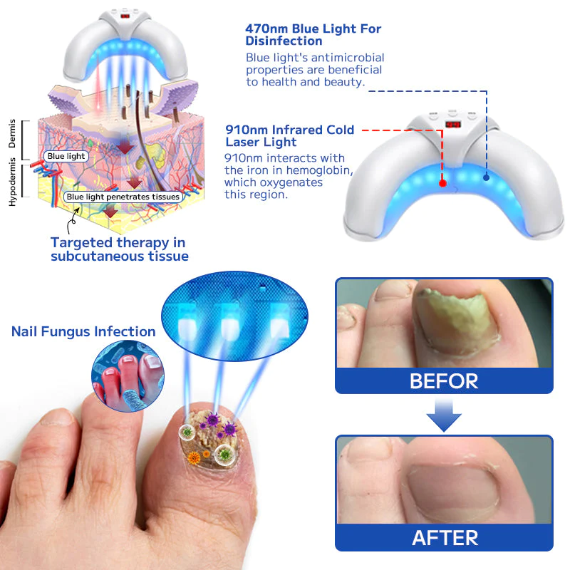 Furzero™ Swam Nael Behandeling Laser Toestel